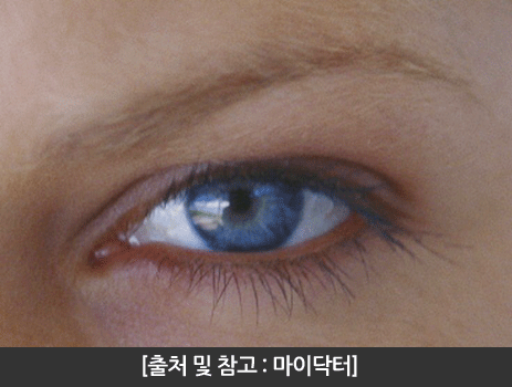 마이크로라식