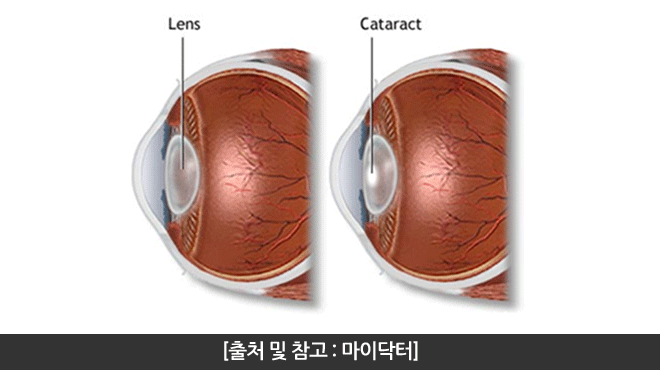 백내장 수술방법