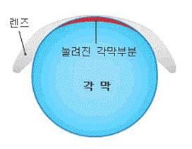 드림렌즈 특징